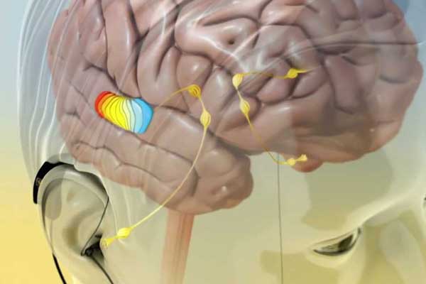 Neurological-Related-Tinnitus