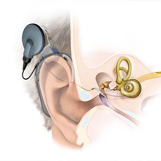 Cochlear-Implant