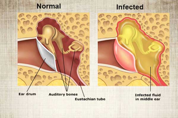 Middle-Ear-Infection
